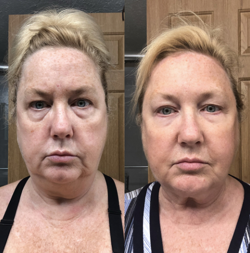 My digestive system, night and day different. Super, super excited about my gut. Didn’t really ever think I had an issue, I do. I loved it! I can tell a difference in my skin, in the tightness of it. Week three I could tell a difference.
